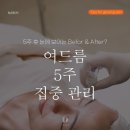 바이디온 여드름 집중관리 5주 후기｜눈에 보이는 Before &amp; After