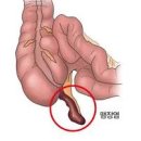 급성 만성 맹장염 초기 충수염 원인 맹장 터지는 이유 여자 맹장 위치 이미지