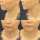 선릉역피부과에서 50대 티타늄리프팅 해준 내돈내산 후기