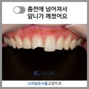 시그니처스마일치과의원 | 건대 치과 : 깨진 앞니 레진 치료 + 일본인 환자 분 감동 편지 후기!