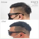 스칼프K 이미지