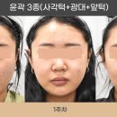 윤곽3종 (광대, 사각턱, 앞턱) - 리스펙성형외과 김기웅원장의 윤곽이야기
