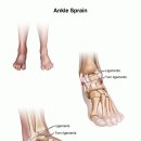 Ankle Sprain 이미지