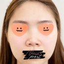 들창코 | [들창코성형] 코수술 3개월차 들창코 작은코 비대칭코 개선후기