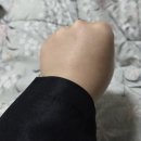 인천마디병원 | 인천 팔 지방흡입 후기 당일~5일차 (전후비교사진)