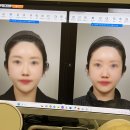 지민45 | [내돈내산] 비염수술 후기 / 실비환급금 아주 다네요