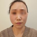 (주)대원메딕스 | 땅콩형얼굴 볼페임 고민, 수원 콜라겐실리프팅 상담 및 후기