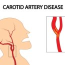 뇌로 가는 이것 좁아지면 뇌졸중 위험…각별히 주의해야 이미지