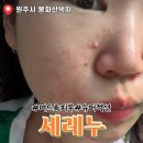 투썸플레이스원주단계봉화산점 | 원주 봉화산택지 세레누, 원주피부관리 흉터케어 슈퍼젝션 후기