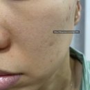 땡쓰미미 | [써마지 정품인증 병원] 써마지 600샷 가격 및 효과(비포/애프터) 마취크림 통증 내돈내산 찐후기ㅠㅠ