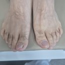 영종도 내성발톱 무좀치료 안전히 해결