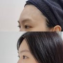 [이마필러, 리부팅의원] 이마필러 2cc로 자연스러운 라인 완성