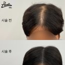 레이븐스칼프 이미지