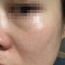 세안의원 | 루나의원 루비레이저 3주 후기(+관리법)