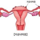 생리전 아랫배 묵직 심할 때 통증 원인 잡으려면? 이미지