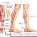 종아리 통증 이미지