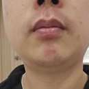 파크뷰의원 | [웨딩] 천안 불당동 유파인 의원 남성 레이저 수염제모 내돈내산 1회차 후기