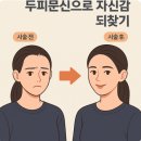 수헤어라인 이미지