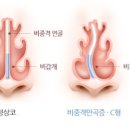 잠잘때 코막힘 비중격만곡증부터 비염까지 약 치료 예방법까지 이미지