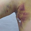 하얀멍이 | 담소유병원 부유방 수술 후기 2 (~1주차) 수술비용