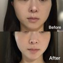 통증 잡는 마사지볼 | 부산 온다 리프팅 후기｜연산동 피부과에서 60kj받고 얼굴라인 달라진 내돈내산 후기