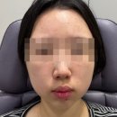 킹스의원 | 수원 인계동 톡스앤필 무턱 턱끝필러 주름보톡스 내돈내산 후기