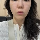 텐 프로 | 선정릉피부과 텐써마 후기(정품팁 확인 필수)