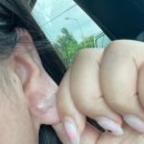 박성원외과의원 | 울산 피지낭종 제거 외과 / 귓볼 피지낭종 따흐흑 제발 생기지마