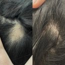 [위례탈모관리샵] 충분한 임상실험OK! 후기로 증명하는 효과OK! 두피생장술은 역시 지오두피연구소