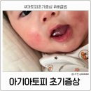 행복한소아청소년과의원 | 아기 피부 오돌토돌 아토피 초기 증상 관리 방법
