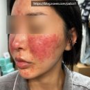 명심한의원 | 주사피부염 피부과 추천 후기 진물 홍조 가려움까지 해결