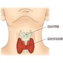 갑상선 여포암 (Follicular thyroid cancer) 이미지