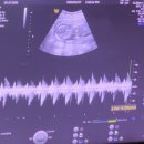 광복회 부산광역시 수영구지회 | [임신중기_16주3일] 임신중기 2차 기형아 검사&amp;결과