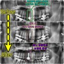 블랑쉬형치과의원 | 앞니 임플란트의 과정과, 임시치아 및 뼈이식과 기간은? (인천치과) 당일 수술