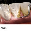 "스케일링" 치석 제거 후 7문7답 이미지