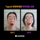 강동실비 | 안면비대칭교정, 보험 실비 가격 전후 후기 총정리