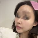 부산 서면피부관리 통증 없는 물광주사 샤이니터치 후기 스킨올 서면전포점