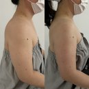 천안팔뚝관리 1회만으로 눈에 띄는 변화를 만든 티리온X 후기