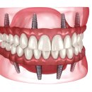 양평하나로치과의원 | 양평치과 전악임플란트 이렇게