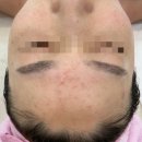 구미피부관리 여드름&amp;문제성피부 에이원뷰티에서 해결!
