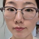 사소하게 | 부산 서면 다크서클 울트라콜 쥬베룩 눈밑 후기(부작용,통증,마취,회복기간) 한달차 변화