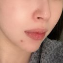 신사역성형외과 코재수술 한달차 후기 (소소한 꿀팁까지)