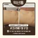 신세계대구점메트로시티 | 덕산동] 끌리메 대구점, 출산 후 늘어진 복부 고민 슬리마이저로 해결하고 온 솔직한 대구피부관리 후기!