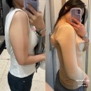 제씨네일 | 팔뚝 지방흡입 후기 멍, 붓기? 부작용인가