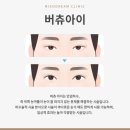 아이버 | 아이버츄 비용 후기 가격 부작용 피부과 시술 원리 눈가 고주파 리프팅 버츄RF