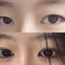 그리다성형외과의원 | 처진 눈꼬리와 흐릿한 눈매 개선! 그리다 성형외과 비절개 눈매교정 실제 후기