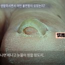 홀드핀칭 이미지