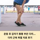 시흥안심정형외과의원 | 갑자기 퉁퉁 부은 다리, 다리 근육 파열 치료 후기