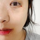 청구병원후문(CCTV) | 눈물샘 수술 후기 결막비강누낭문합술(존스관삽입)