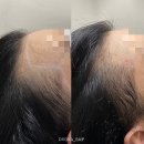 곱슬머리헤어라인